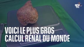 801 grammes, 13,37 cm... Le plus gros calcul rénal au monde retiré sur un retraité au Sri Lanka