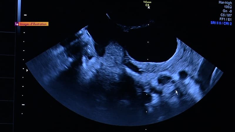 Infertilité en France : "beaucoup de femmes ne sont pas renseignées"