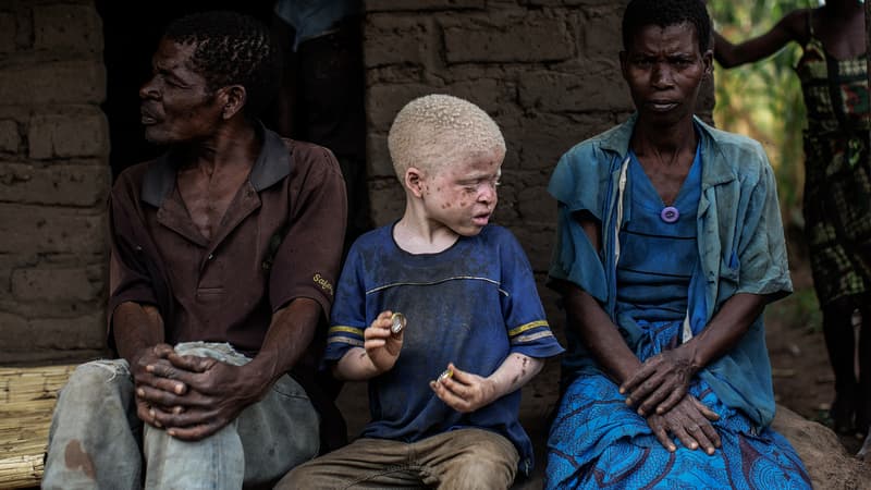 Mozambique: un père qui voulait vendre ses trois enfants albinos arrêté