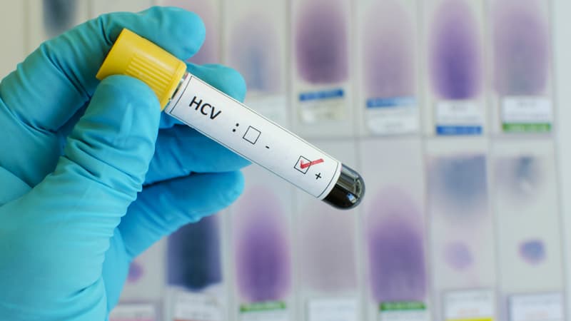 Diagnostic de l'hépatite C