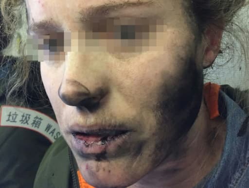 Photo prise le 19 février 2017 d'une Australienne brûlée au visage et au cou par ses écouteurs qui ont pris feu durant un vol entre Pékin et Melbourne Photo prise le 19 février 2017 d'une Australienne brûlée au visage et au cou par ses écouteurs qui ont pris feu durant un vol entre Pékin et Melbourne