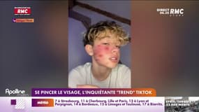 Se pincer le visage, l'inquiétante "trend" Tiktok 