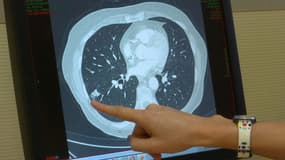 Cancer du poumon: le dépistage par scanner pourrait-il sauver des milliers de vies?