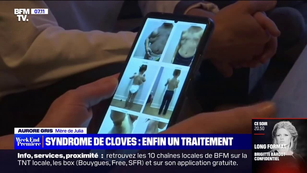 An effective treatment for Cloves syndrome Awutar