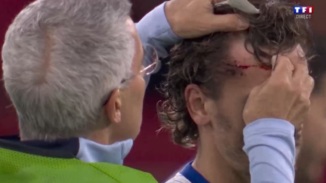 Franche-Autriche: les images de Griezmann avec le front en sang après un choc contre le panneau publicitaire, le 17/06/2024 Franche-Autriche: les images de Griezmann avec le front en sang après un choc contre le panneau publicitaire, le 17/06/2024