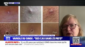 Rosamund Lewis (responsable technique à l'OMS pour la variole du singe): "Il y a des traitements spécifiques qui sont en cours d'investigation"