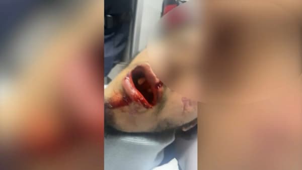 Sofiane après l'agression dont il a supposément été victime, le 13 juillet 2022