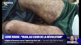 LIGNE ROUGE - Cet homme de 28 ans a reçu plus de 200 balles de plomb dans le corps, lors d'une manifestation en Iran