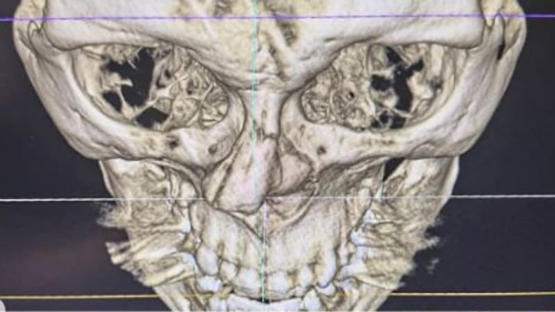 Les impressionnantes photos et radios du nez fracassé de Merab Dvalishvili