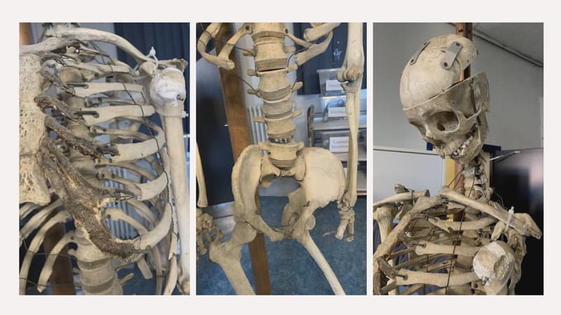 Le squelette Oscar traînait dans le lycée international de Clermont-Ferrand depuis des décennies.