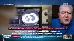 Une étude montre que le Covid-19 peut aussi produire des lésions cérébrales