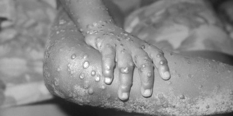 Le bras et la jambe d'une fillette atteinte de la variole du singe. 