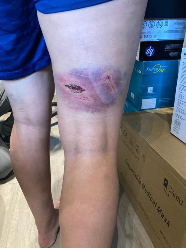 Les hématomes sur les jambes de Kheira Hamraoui, agressée le 4 novembre 2021