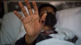 Un patient touché par le virus mpox, la "variole du singe", dans un hôpital de Lima (Pérou), le 16 août 2024.