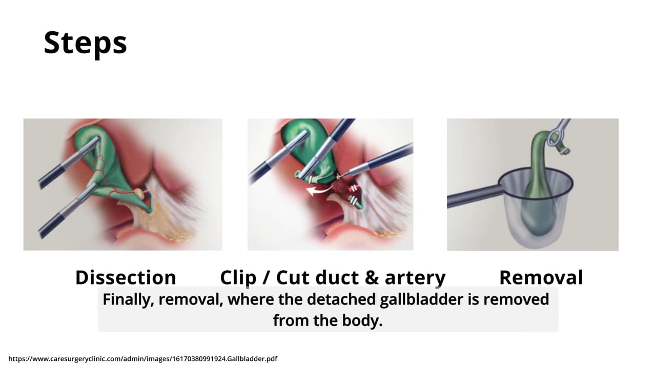 Les étapes suivies par le robot SRT-H lors de l'opération.