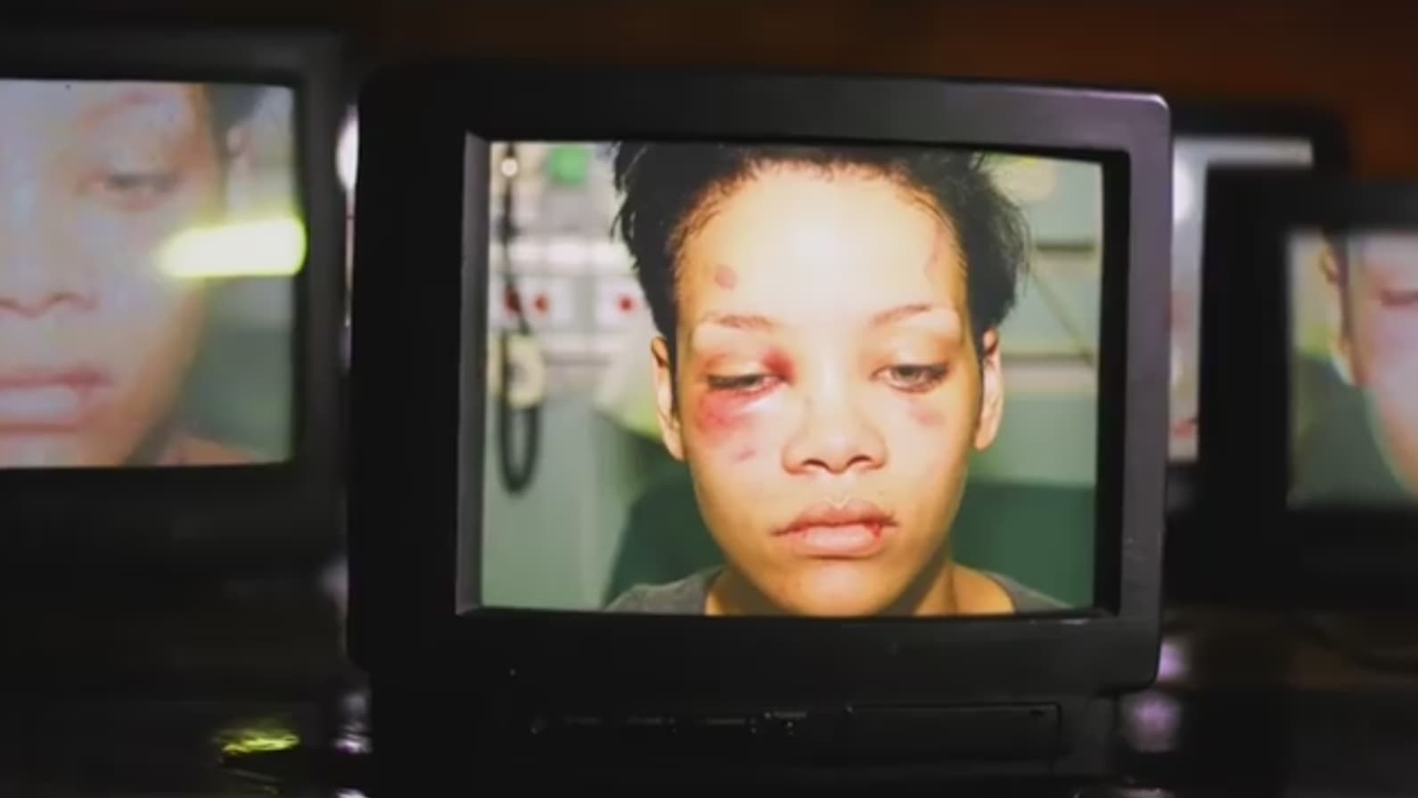 Les photos du visage de Rihanna après l'agression de Chris Brown Les photos du visage de Rihanna après l'agression de Chris Brown