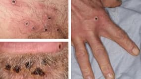 Collage de photos de lésions provoquées par la variole du singe, le 22 juin 2022