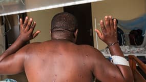 Un homme infecté par le Mpox montre son dos à l'intérieur d'une salle du centre de traitement à Bujumbura, au Burundi, le 22 août 2024.