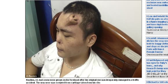 Xiaolan, un Chinois a la face mutilée par un accident de voiture, a un nez sur le front. Xiaolan, un Chinois a la face mutilée par un accident de voiture, a un nez sur le front.
