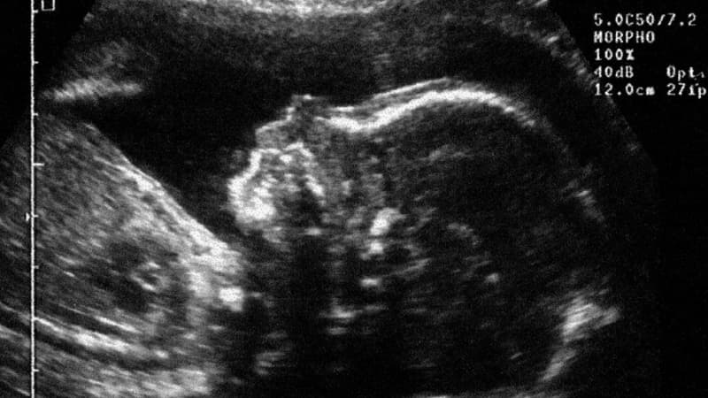 Echographie d'un fœtus réalisée cinq mois après la conception. 