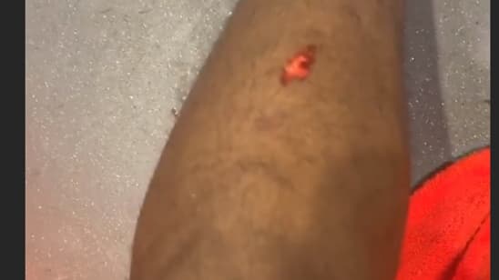 Le tibia gauche