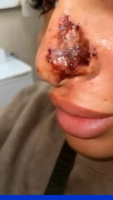  "Elle m'a dit que c'était l'hématome": les injections illégales de botox font des ravages 