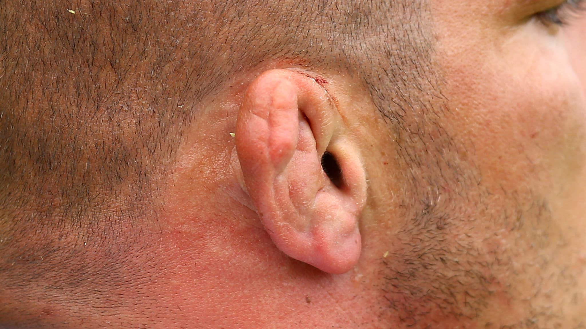 L'oreille de Djalil Narjissi, rugbyman internation marocain qui a fait sa carrière au poste de talonneur
