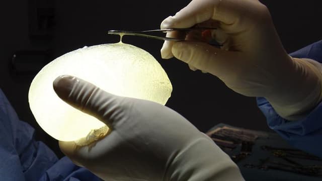 Prothèse PIP défectueuse explantée lors d'une intervention chirurgicale dans une clinique de Nice.Le gouvernement français a recommandé vendredi le retrait "à titre préventif mais sans caractère d'urgence" des prothèses mammaires PIP qui ont été implantée