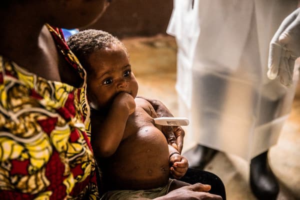 Un enfant infecté par la variole du singe, à Zomea Kaka, en République centrafricaine le 18 octobre 2018.