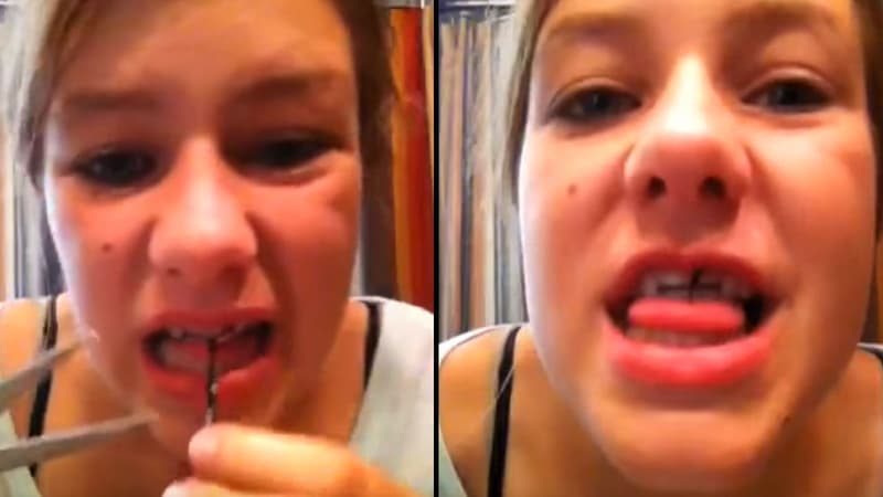 Dans une vidéo mise en ligne sur Internet, cette jeune fille explique comment réduire l'espace entre ses incisives au moyen d'un simple élastique à cheveux. Une pratique dangereuse, alerte la Fédération française d'orthodontie.