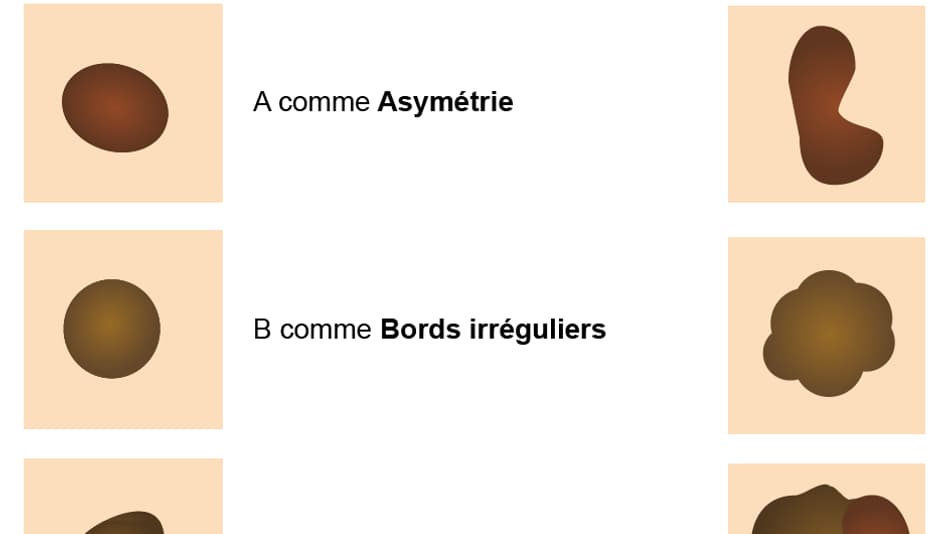 grains de beauté