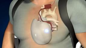 Cœur artificiel: un 3e patient greffé