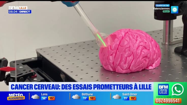 Un essai clinique pour combattre le cancer du cerveau au CHU de Lille.