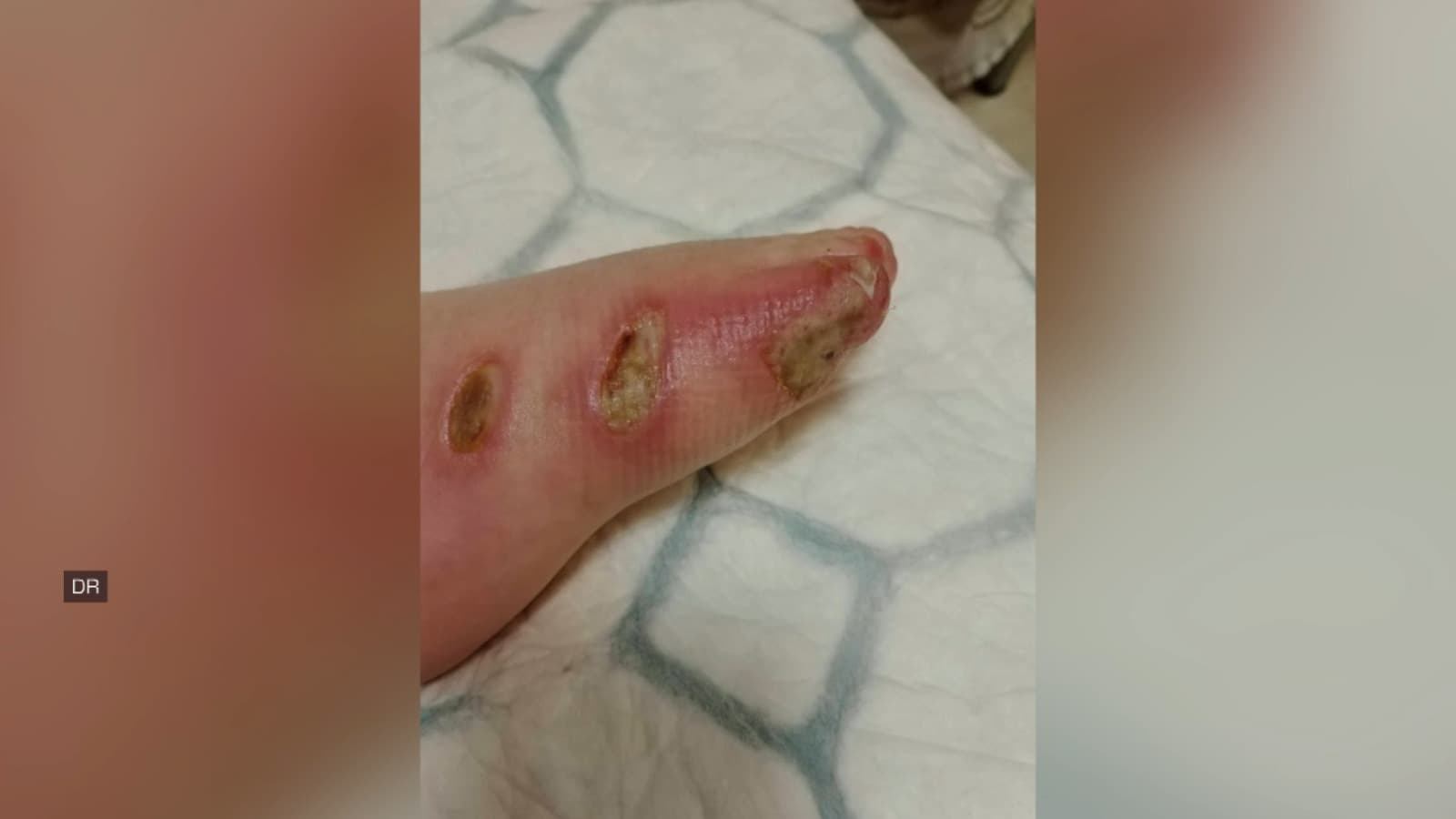 Illia, neuf ans, vient de subir une greffe de peau après s’être grièvement blessé le pied et la fesse au contact d’un radiateur à une température anormalement élevée à Francheville.