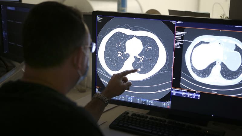 Un radiologue montre le scanner pulmonaire d'une personne atteinte d'un cancer du poumon, à Ajaccio le 16 décembre 2021 (photo d'illustration).