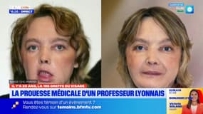 Il y a 20 ans, la prouesse d'un lyonnais : la 1ère greffe de visage