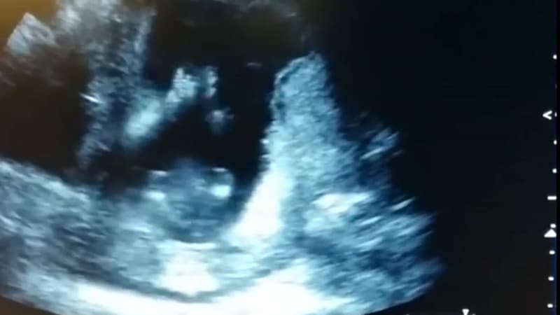 Les parents de ce futur bébé ont eu une agréable surprise lors de l'échographie