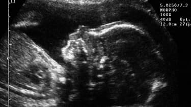 Echographie d'un fœtus réalisée cinq mois après la conception.