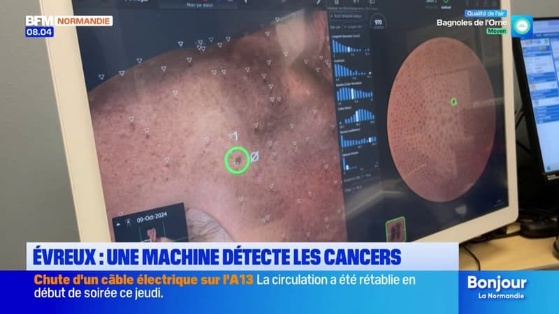 Évreux: une machine aide à détecter les cancers de la peau grâce à l'intelligence artificielle