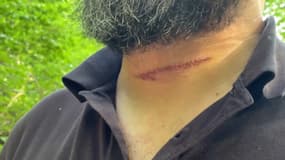 Un vététiste a été blessé au cou par un fil tendu entre deux arbres, dans les Vosges. 