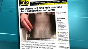 Une pince de 15 cm, logée dans l'abdomen, a été oubliée par le chirurgien.