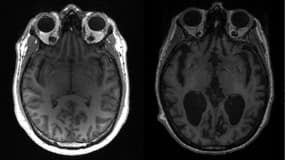 Un cerveau sain (à gauche) et un cerveau d'une personne atteinte de la maladie d'Alzheimer (à droite).