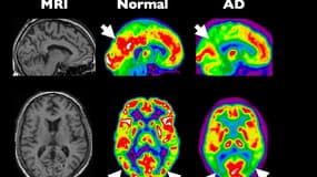 Les nouveaux systèmes d'imagerie permettent de mesurer l'activité en différentes zones du cerveau. Ici, la comparaison entre un organe sein et un touché par la maladie d'Alzheimer.