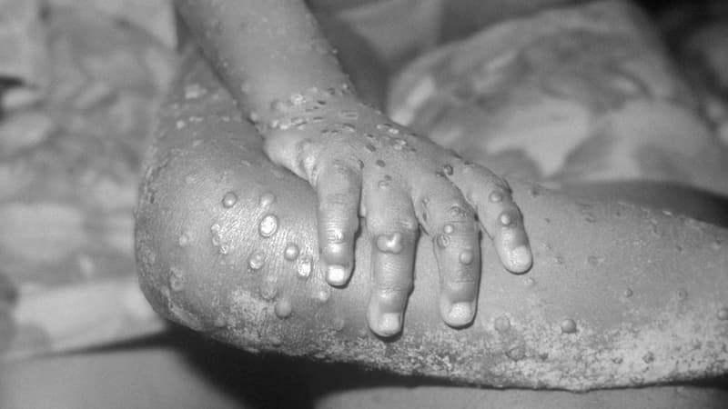 Le bras et la jambe d'une fillette atteinte de la variole du singe. 