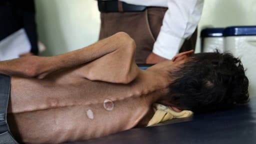 Un enfant yéménite victime de malnutrition - Image d'illustration