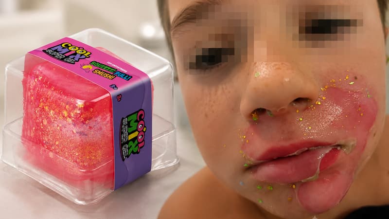 "Il lui a éclaté au visage": un jouet "squishy" explose et brûle grièvement un enfant de 8 ans