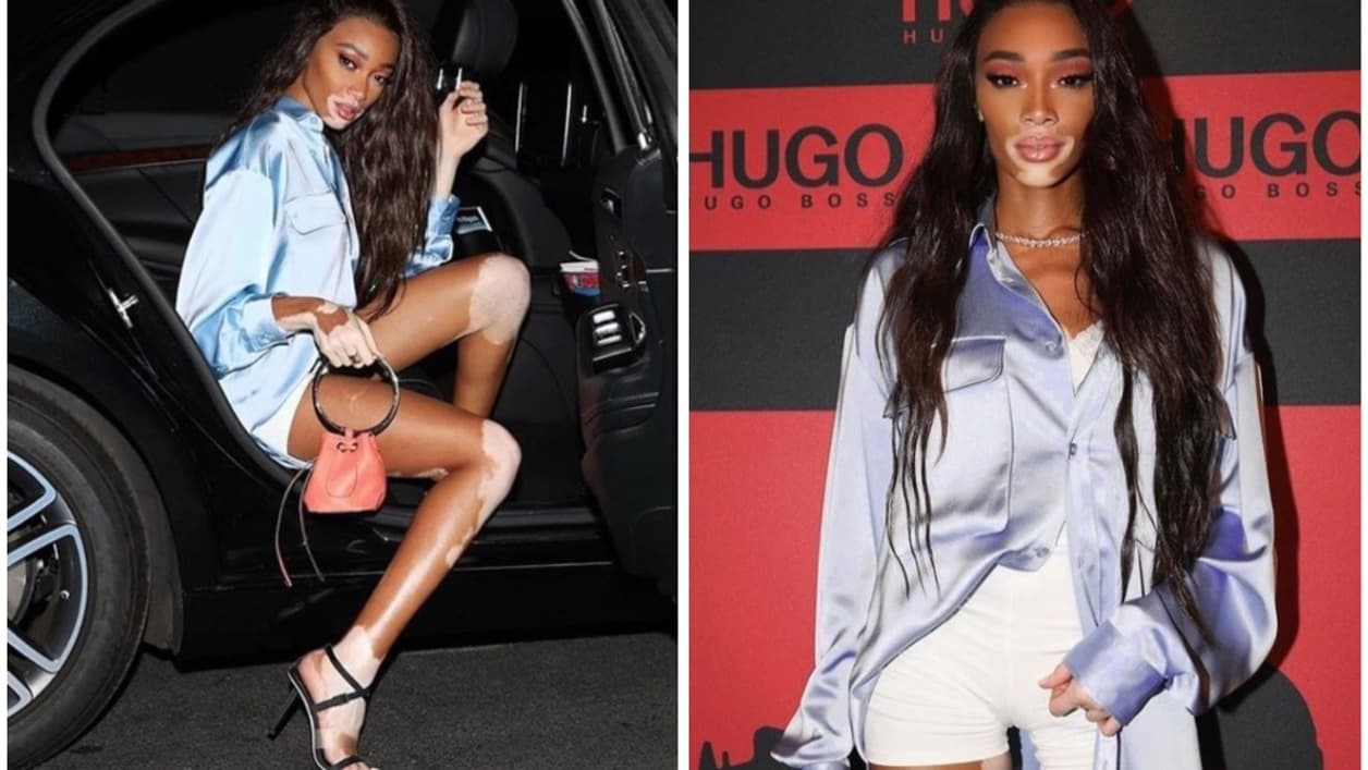 Winnie Harlow Winnie Harlow