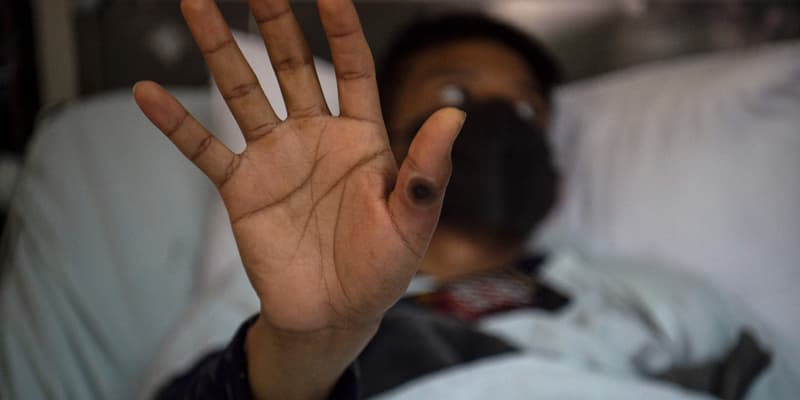 Un patient montre sa main avec une plaie causée par une infection par le virus de la variole du singe, à l'hôpital Arzobispo Loayza, à Lima, le 16 août 2022. (Photo d'illustration)