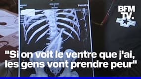  "Je n'ose même plus aller à la plage": une pince chirurgicale de 20 centimètres a été oubliée dans l'abdomen d'un patient