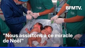 Pérou: deux sœurs siamoises séparées avec succès lors d'une opération complexe 